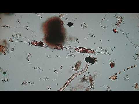 Gli ultimi focolai globali dei ‘batteri carnivori’